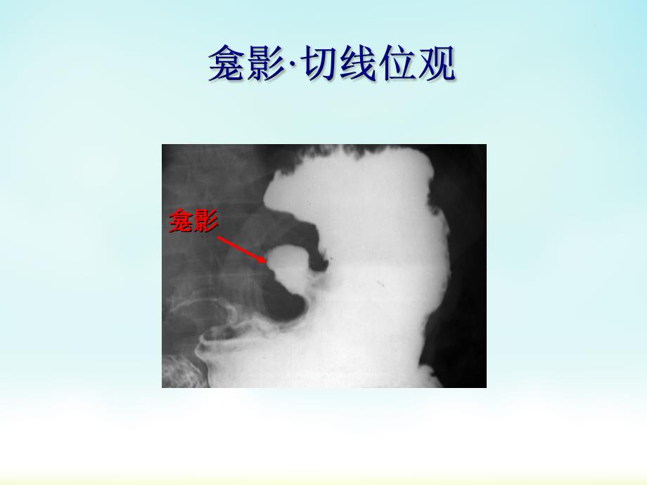 消化系统异常影像表现课件_第4页