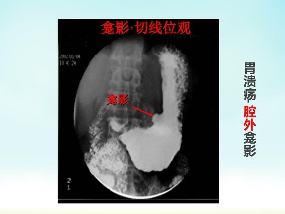 消化系统异常影像表现课件_第5页