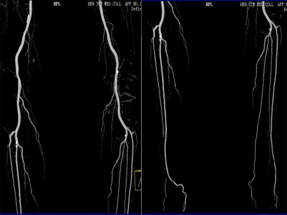 层ct血管成像诊断下肢动脉闭塞及狭窄性疾病的临床应用3影像学课件_第5页
