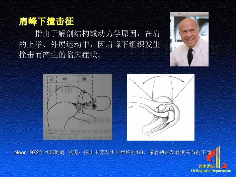 小切口与关节镜下肩峰成形术课件_第2页