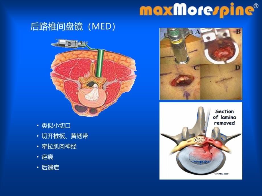 椎间孔镜幻灯课件_第5页