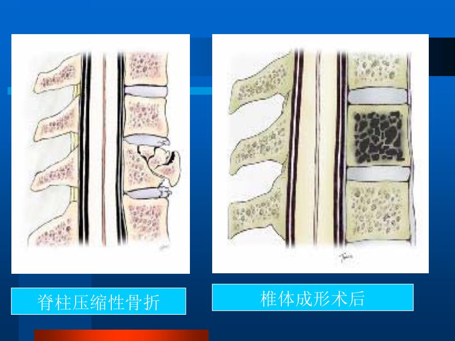 椎体成形术（pvp）课件_第3页