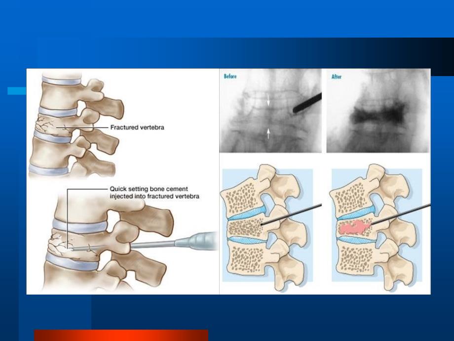 椎体成形术（pvp）课件_第4页