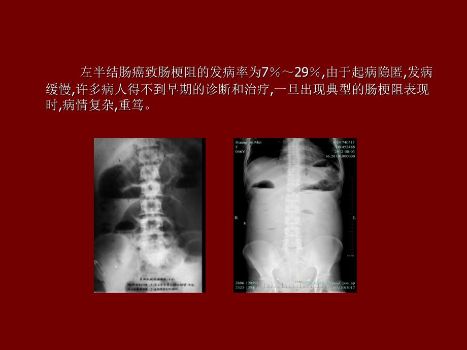 扩大右半结肠新课件_第3页