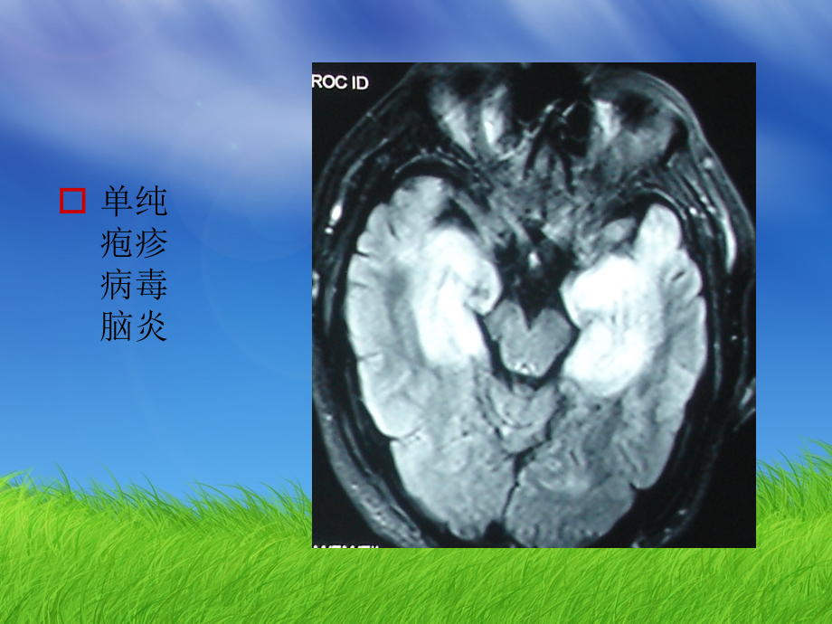 脑炎和脑膜炎康复医学_第4页