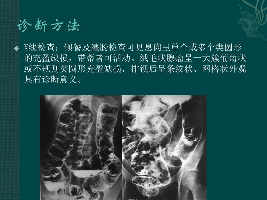 大肠息肉病医学_第5页