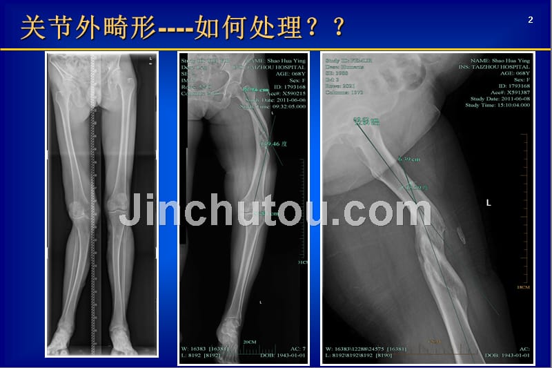 关节外畸形全膝医学_第2页