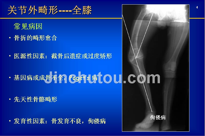 关节外畸形全膝医学_第4页