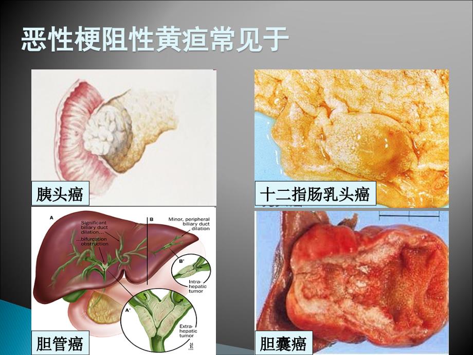 恶性梗阻性黄疸医学_第3页