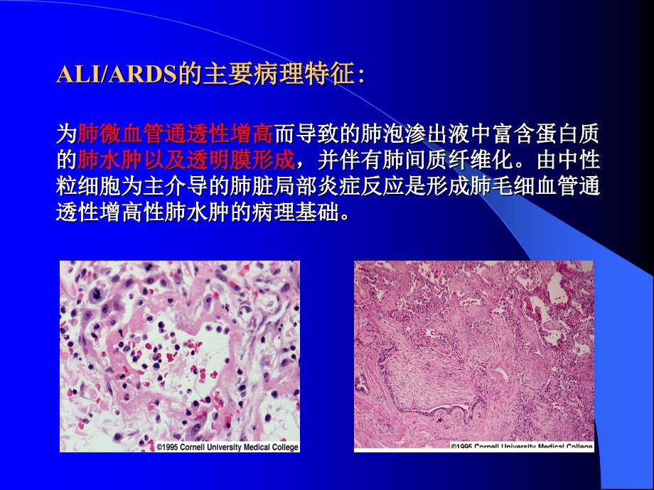 【医学课件大全】急性呼吸窘迫综合征研究进展_第4页