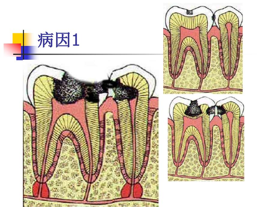 牙髓疾病及治疗方法ppt幻灯片课件_第3页