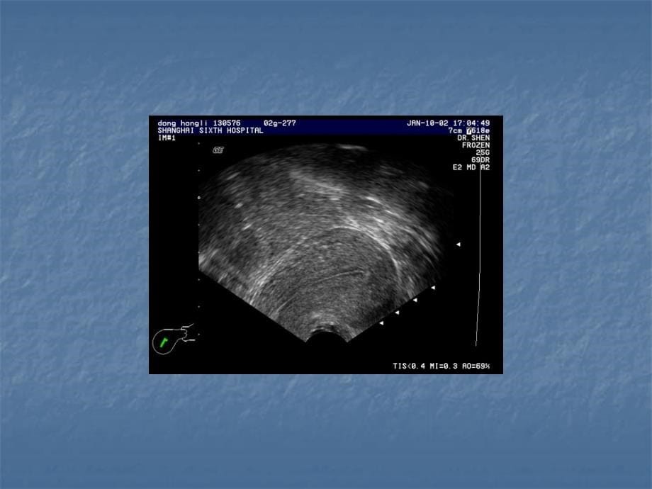 超声诊断学-妇科超声诊断ppt课件_第5页