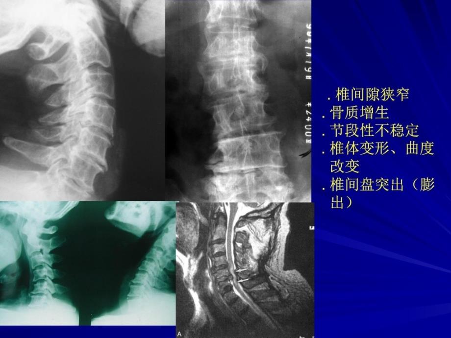 [宝典]椎间盘退变与颈椎病课件_第3页