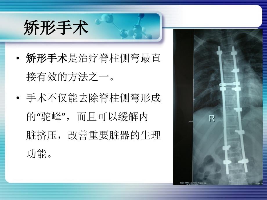 脊柱侧弯矫形术围手术期的呼吸道管理课件_第4页