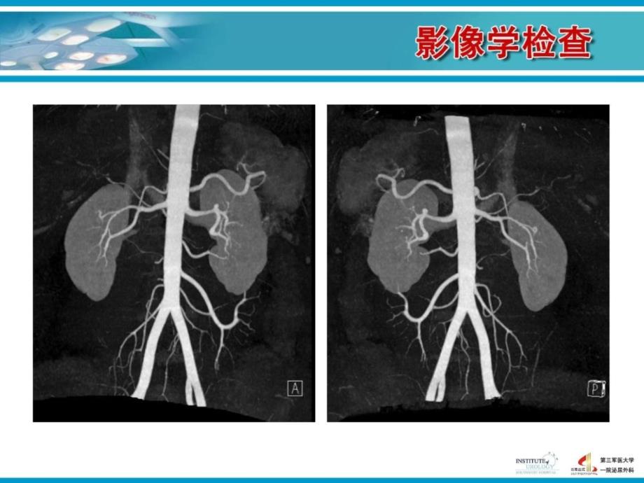 西南医院支轶-后腹腔镜下左肾部分切除术_图文.ppt课件_第4页