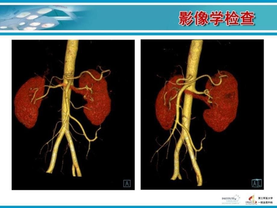 西南医院支轶-后腹腔镜下左肾部分切除术_图文.ppt课件_第5页