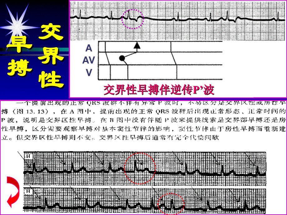 常见心律失常、心肌梗死的心电图诊断交流讲稿（下）课件_第4页