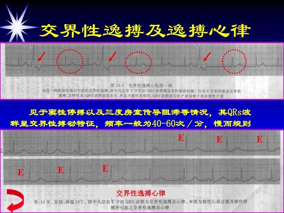 常见心律失常、心肌梗死的心电图诊断交流讲稿（下）课件_第5页