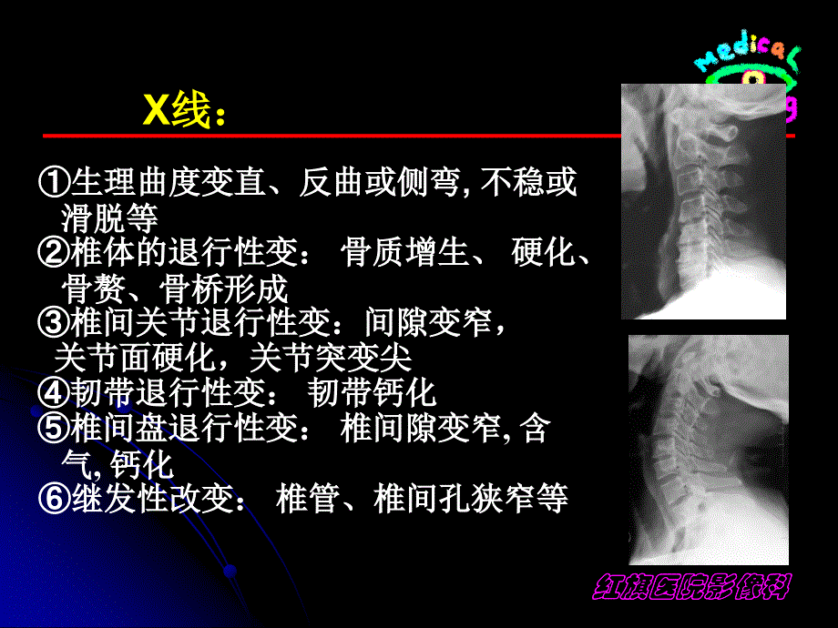 影像诊断课件-退变_第4页