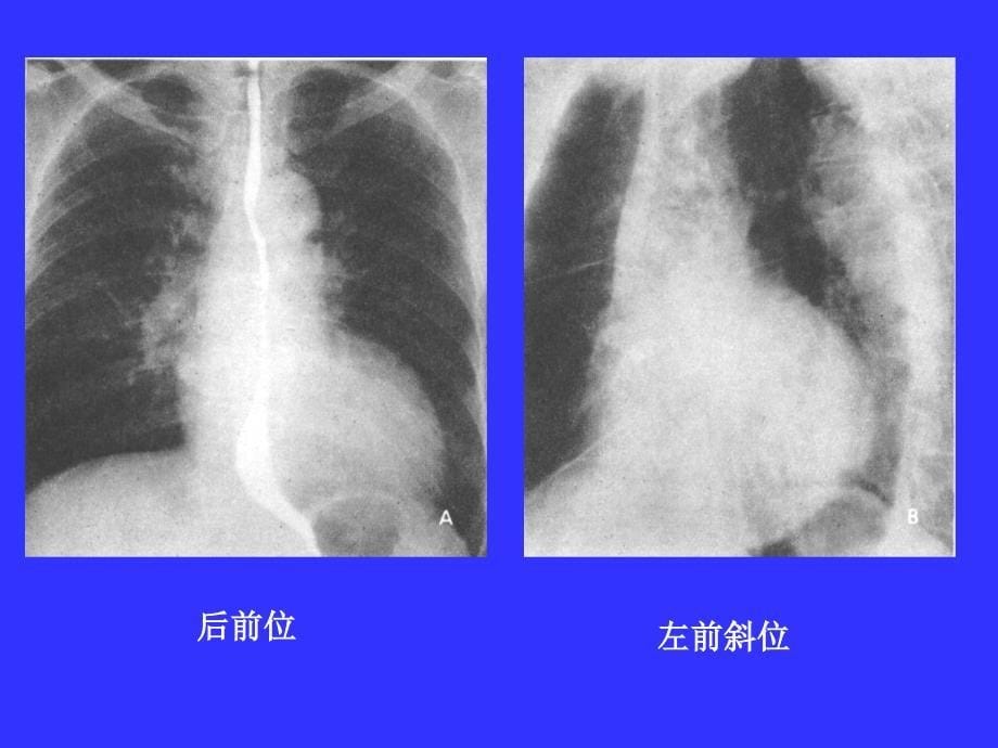 高心肺心病课件_第5页