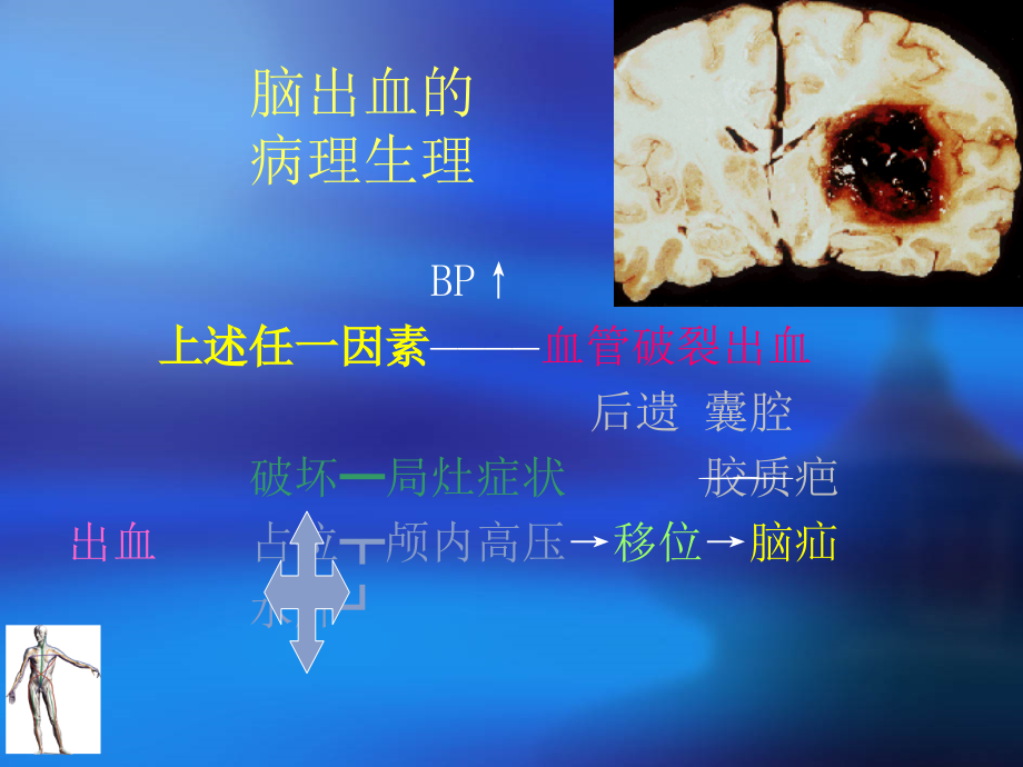 【医学课件大全】脑出血 cerebral haemorrahge (54p)_第2页