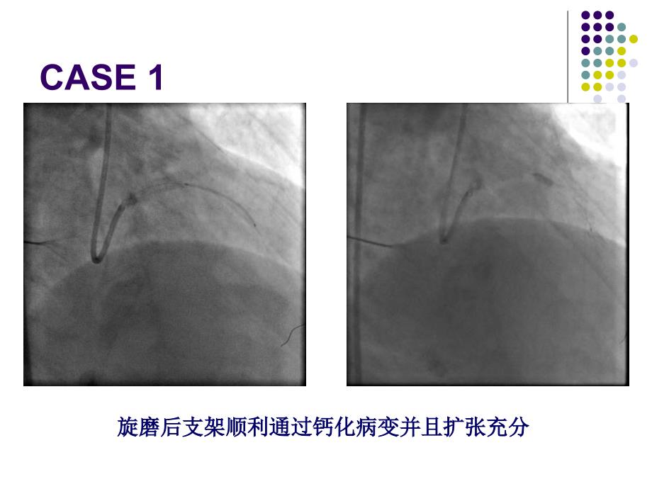 旋磨病历姜铁民_第4页