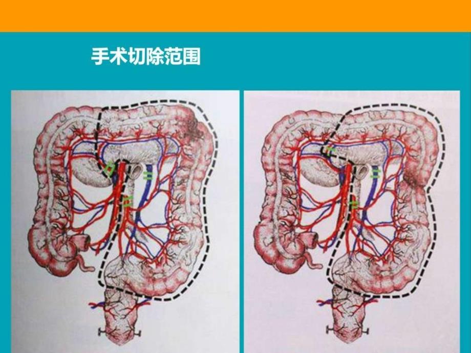 腹腔镜根治性(扩大)左半结肠切除术 ppt课件_图文.ppt_第3页