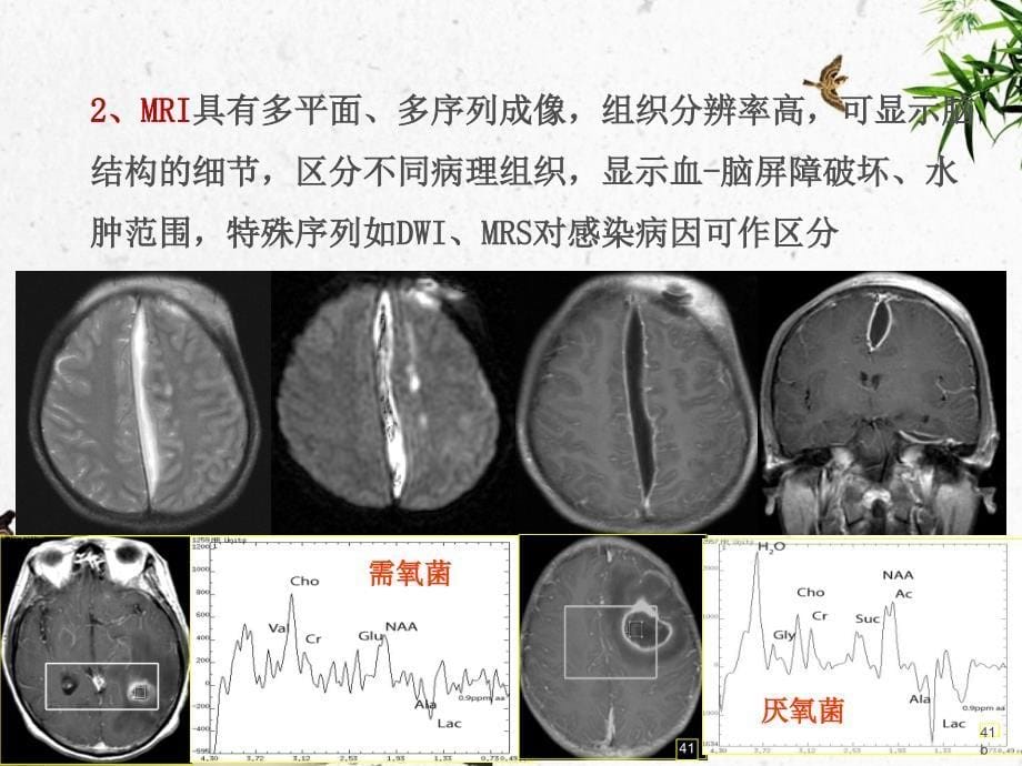 颅内感染性疾病影像诊断与鉴别诊断ppt课件_第5页