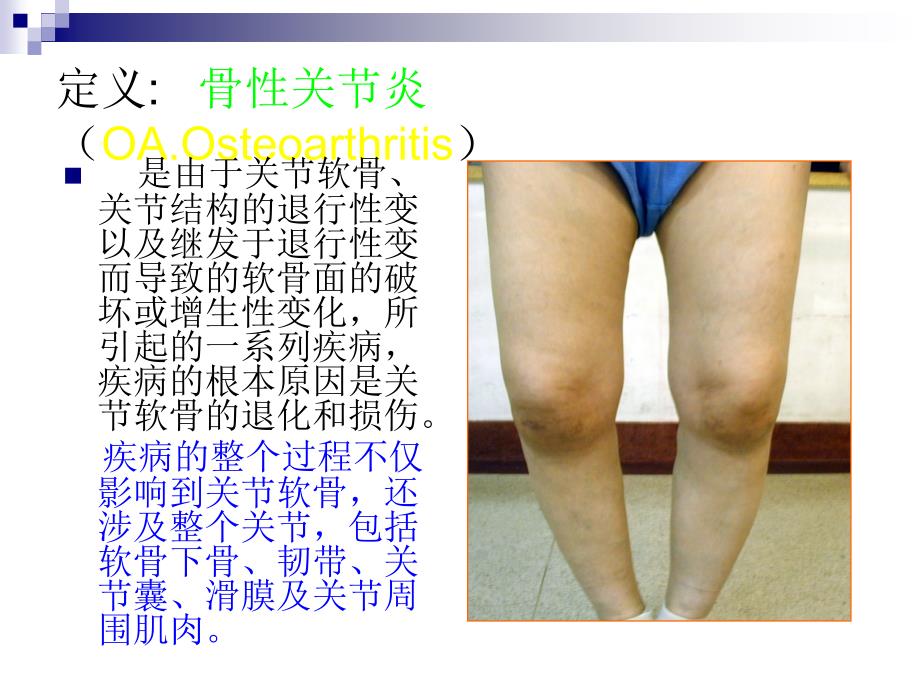膝关节骨性关节炎的中医治疗ppt课件_第2页
