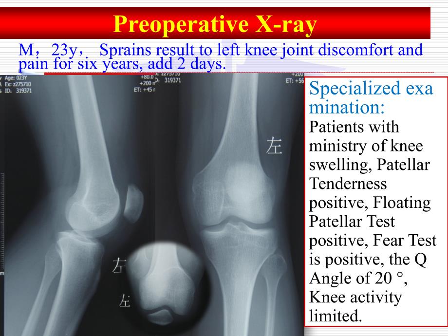 髌骨脱位病例讨论英文版图文课件_第2页