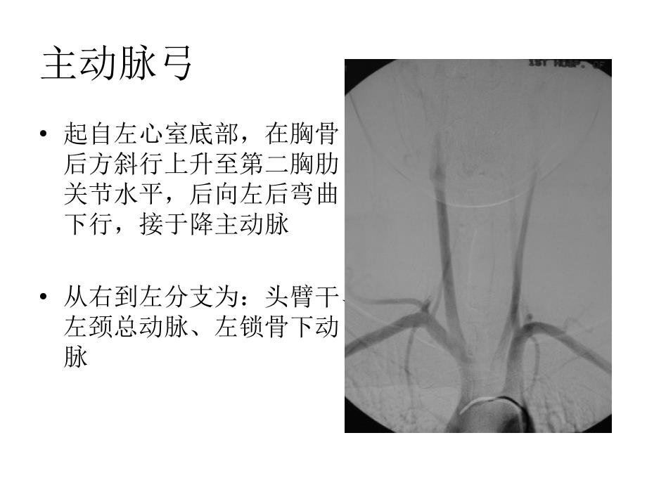 脑血管的常见变异及先天异常ppt课件_第2页