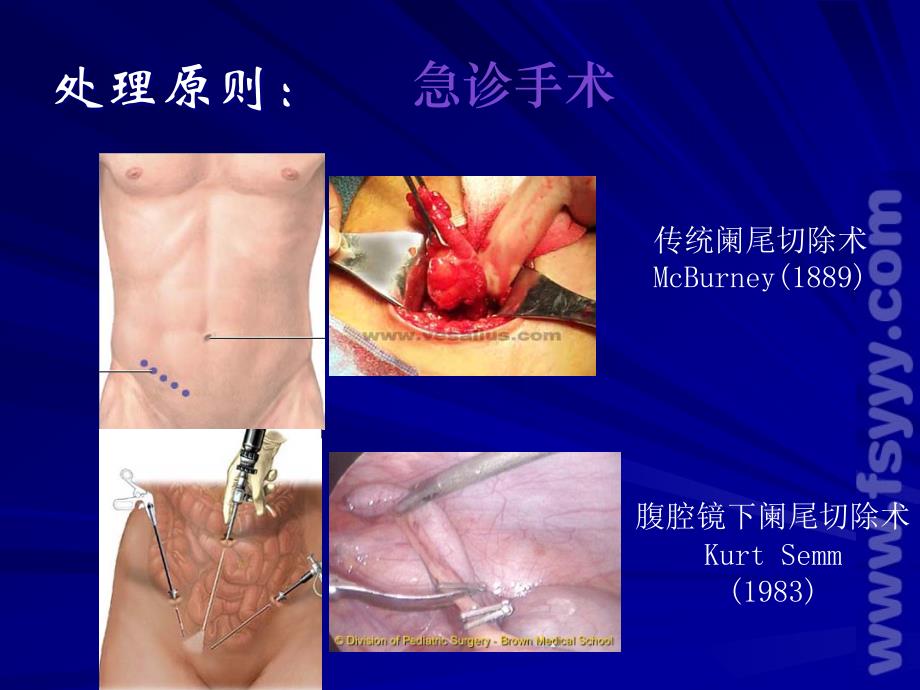 腹腔镜阑尾切胃穿孔修补 ppt课件_第4页