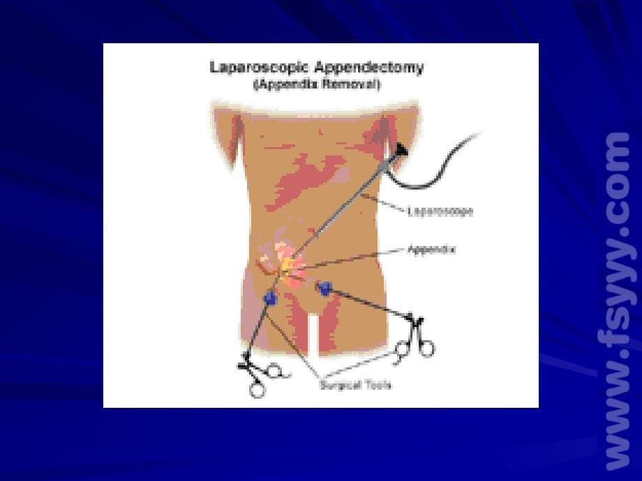 腹腔镜阑尾切胃穿孔修补 ppt课件_第5页