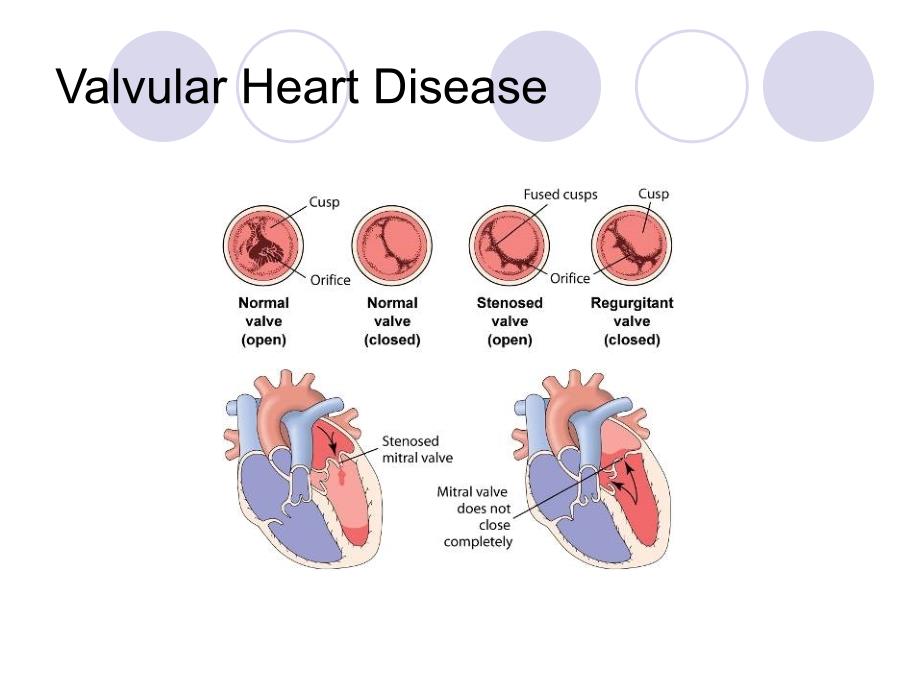 心脏瓣膜病课件（25p）_第2页