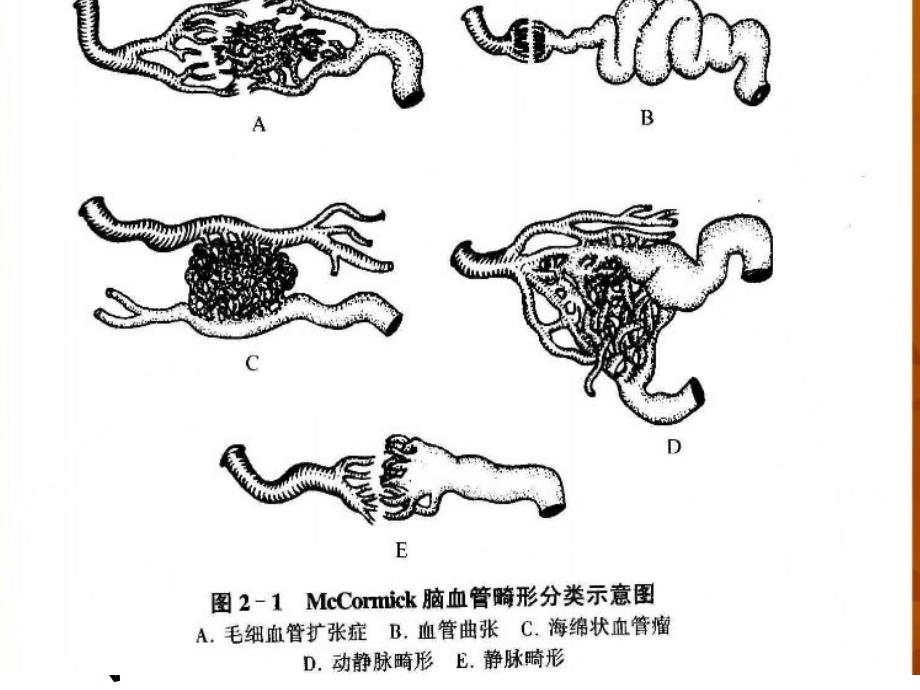 脑血管畸形课件_7_第4页