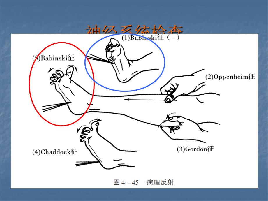 脑梗塞的护理查房（医学ppt）_第3页