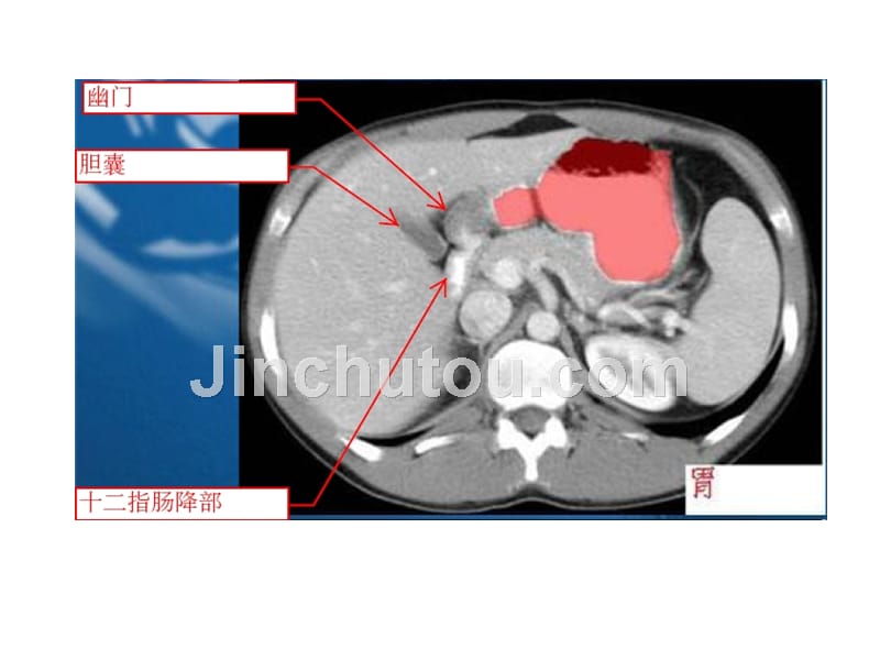 腹部ct精美示意图ppt课件_第4页