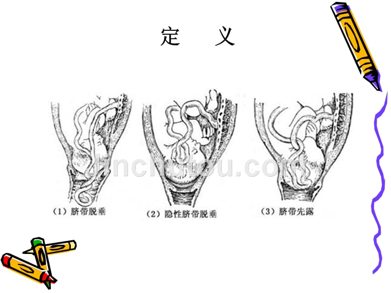 脐带脱垂护理查房ppt要点课件_第4页