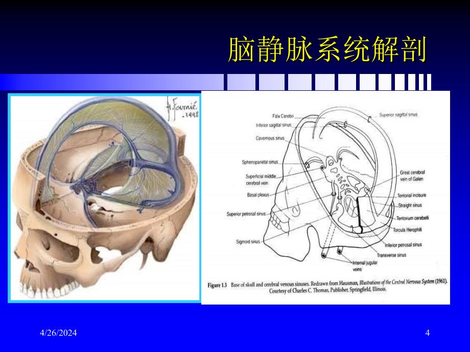 脑静脉和静脉窦血栓形成新进展ppt课件_第4页