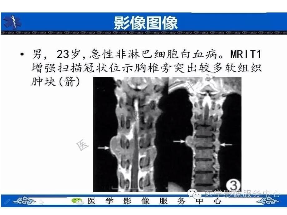 浅谈白血病骨质改变ppt课件_第5页