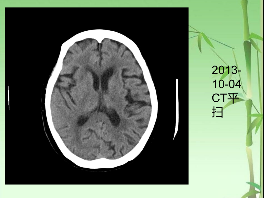 脑海绵状血管瘤影像学诊断及鉴别诊断ppt课件_第4页