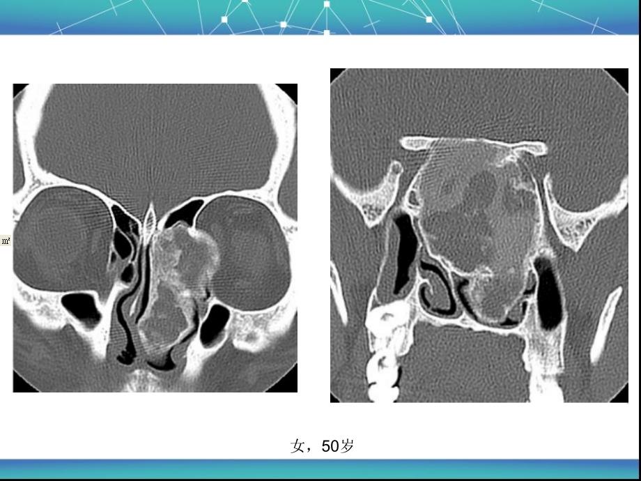 颅面骨骨化性纤维瘤影像诊断ppt课件_第4页