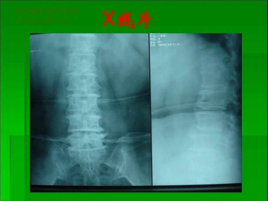 针刀治疗椎管狭窄症ppt课件_第3页