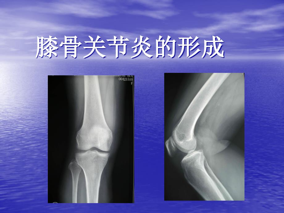 膝骨关节炎健康宣教ppt课件_第3页