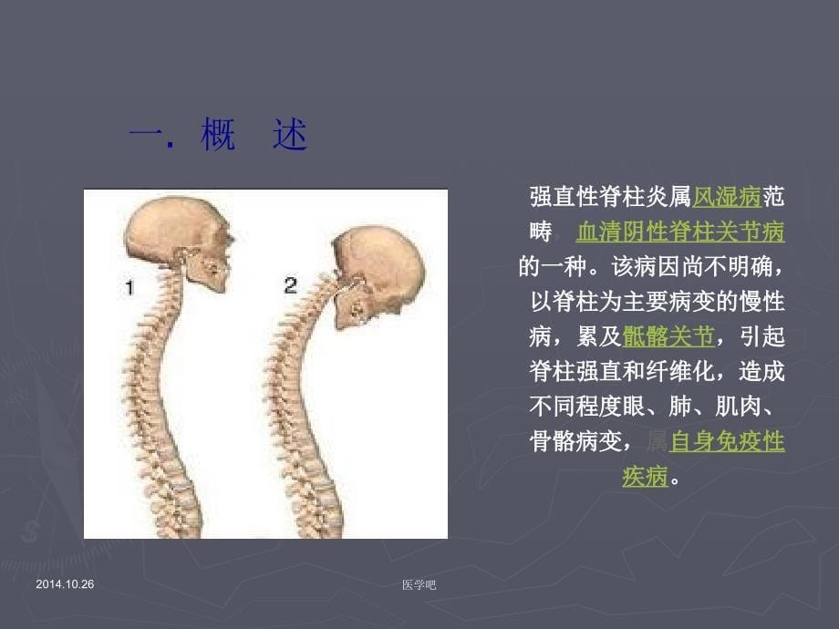 医学课件强直性脊椎炎病人的护理_第5页