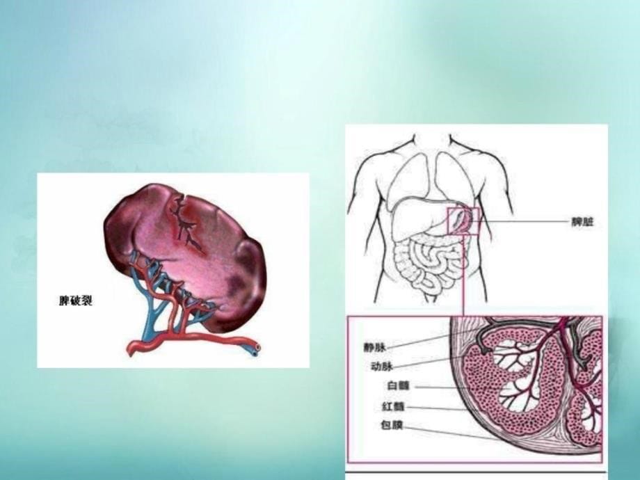 脾破裂课件_7_第5页