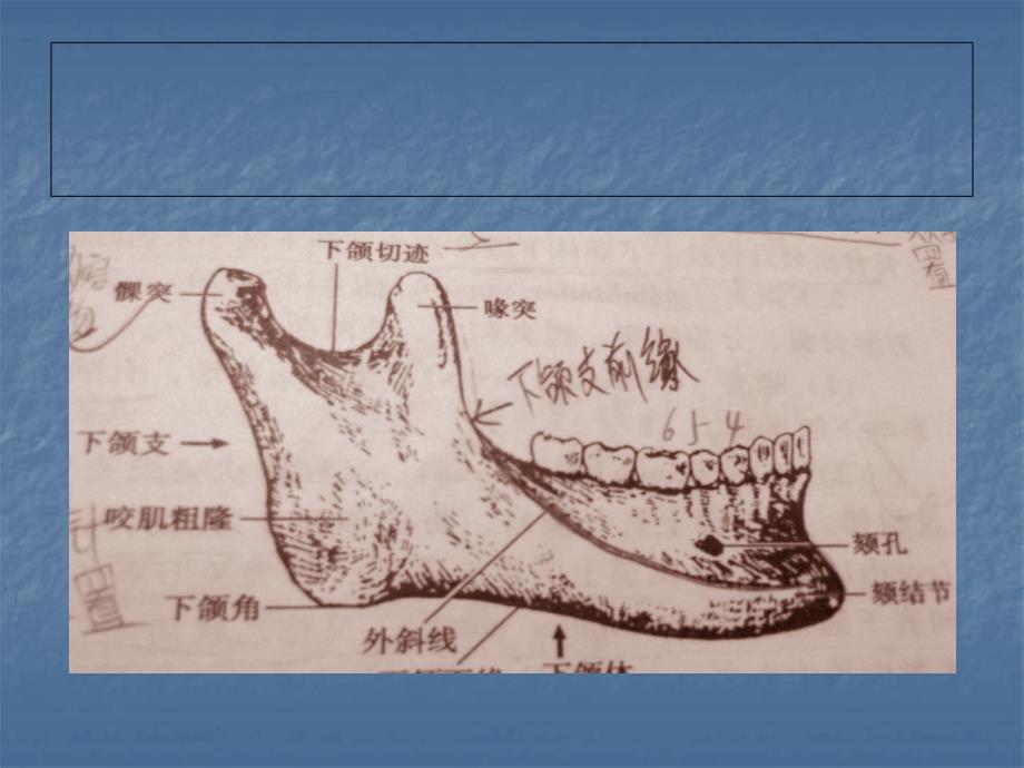 颌骨骨折ppt课件_第3页