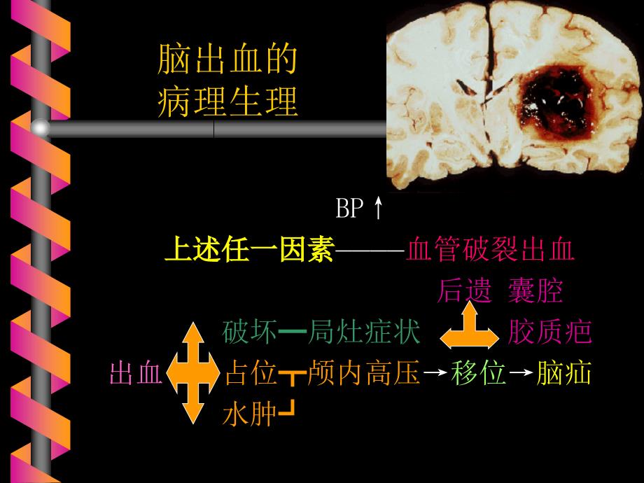 脑出血蛛网膜下腔出血教案ppt课件_第2页