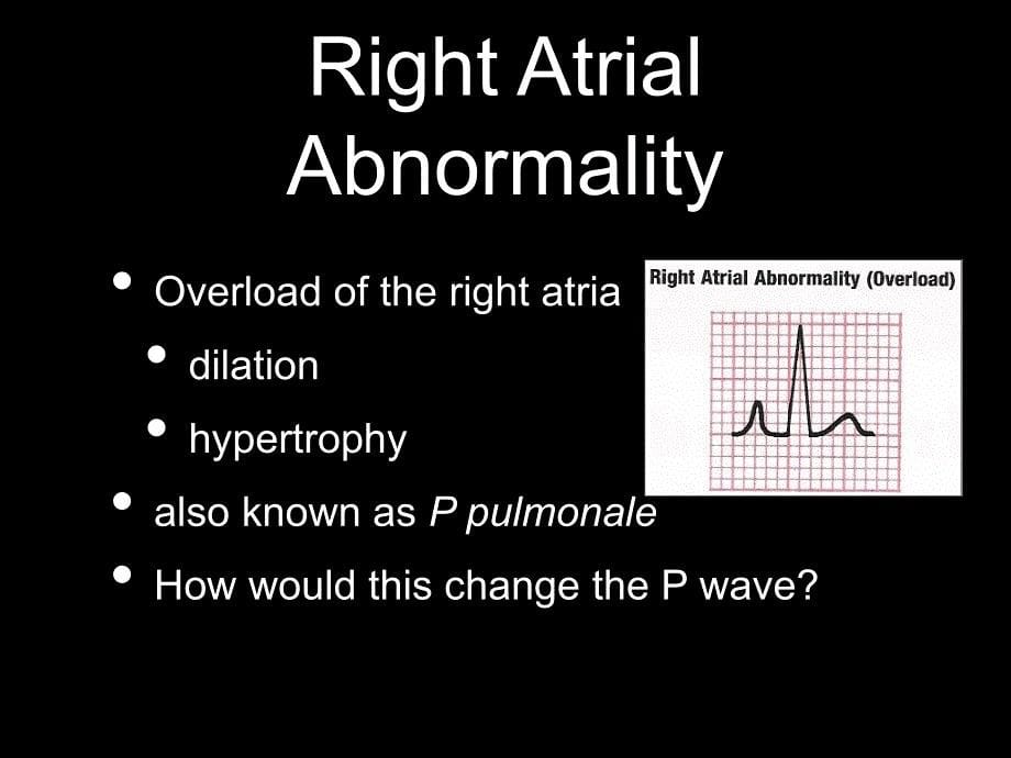 高血压英文ppt精品课件atrialand ventricular _第5页