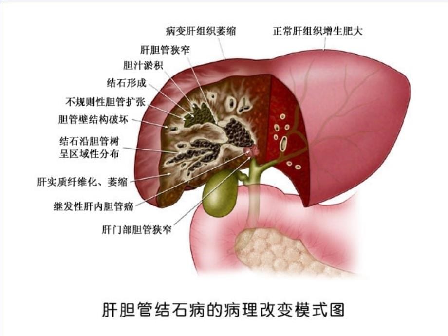 诊断治疗指南（肝胆管结石）资料课件_第5页